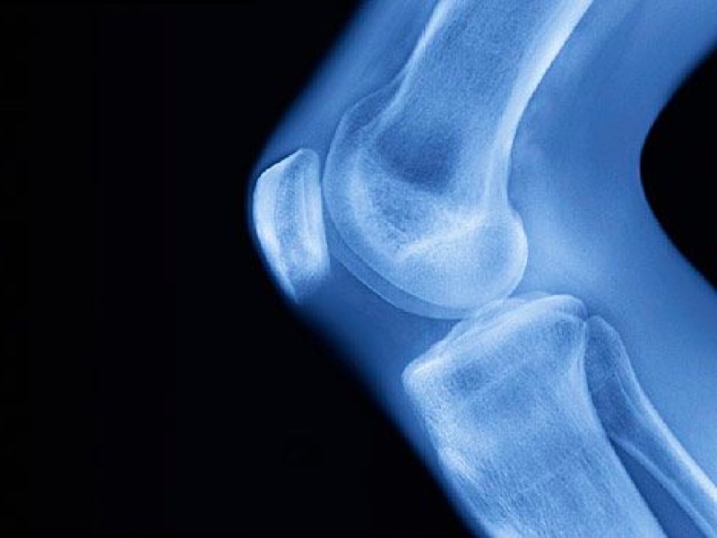Knee Joint Osteoarthritis